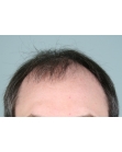 Before Hair Transplant &nbsp;2 Sessions (Areas)